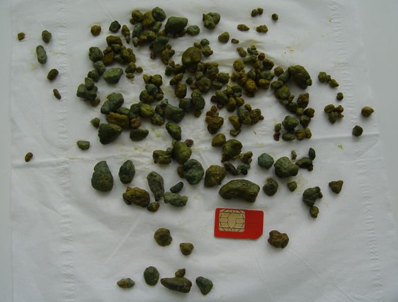 Кал при желчном пузыре. Зеленые билирубиновые камни. Камни желчного пузыря в Кале. Твердые камешки в Кале.
